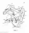 Fig. 03 - Puncture apparatus