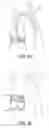 Fig. 40 - Intravascular treatment catheters