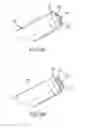 Fig. 07 - Laser ablation catheter