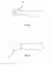Fig. 07 - Surgical drape for use in cesarean sections