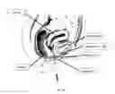 Fig. 04 - INTRAVAGINAL INCONTINENCE DEVICE