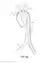 Fig. 07 - System for deploying a device to a distal location across a diseased vessel