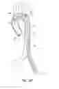 Fig. 19 - System for deploying a device to a distal location across a diseased vessel