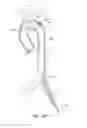 Fig. 20 - System for deploying a device to a distal location across a diseased vessel