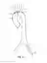 Fig. 26 - System for deploying a device to a distal location across a diseased vessel