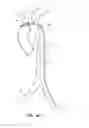 Fig. 27 - System for deploying a device to a distal location across a diseased vessel