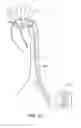 Fig. 42 - System for deploying a device to a distal location across a diseased vessel