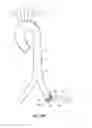 Fig. 49 - System for deploying a device to a distal location across a diseased vessel