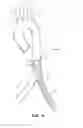 Fig. 51 - System for deploying a device to a distal location across a diseased vessel
