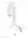 Fig. 61 - System for deploying a device to a distal location across a diseased vessel