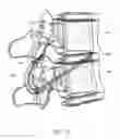 Fig. 33 - Devices and methods for transpedicular stabilization of the spine
