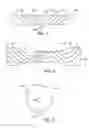 Fig. 02 - Stent Anti-Migration Mechanism