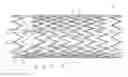 Fig. 01 - Highly flexible stent and method of manufacture