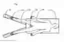 Fig. 02 - Method and Apparatus for Applying and Controlling Surgical Traction