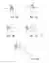 Fig. 09 - Post nasal drip treatment
