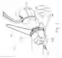 Fig. 07 - Earplug assembly for iontophoresis system