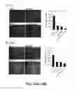 Fig. 13 - Induction of thyroid iodide-handling gene expression in human cancers