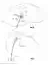 Fig. 06 - SYSTEM AND METHOD FOR ASPIRATING BODILY FLUID