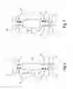 Fig. 03 - Device and method for balancing between an inflow into and an outflow out of a medical treatment device