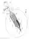 Fig. 03 - GEL DELIVERY CATHETERS, SYSTEMS, AND METHODS