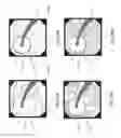 Fig. 26 - Systems, devices and methods for performing medical procedures in the intestine