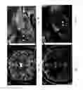 Fig. 07 - Site specific deep brain stimulation for enhancement of memory