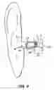 Fig. 04 - Open fit canal hearing device