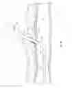 Fig. 09 - Suture-based closure with hemostatic tract plug