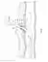 Fig. 10 - Suture-based closure with hemostatic tract plug
