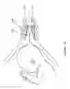 Fig. 23 - Delaying pre-term birth
