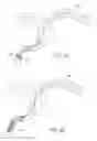 Fig. 08 - Flexible intravascular treatment devices and associated systems and methods of use