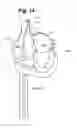 Fig. 18 - Catheter System for Left Heart Access