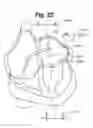 Fig. 24 - Catheter System for Left Heart Access