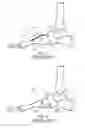 Fig. 06 - Bone securement apparatus and method