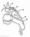 Fig. 01 - Laminoplasty fixation devices
