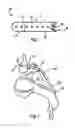 Fig. 02 - Laminoplasty fixation devices