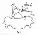Fig. 03 - Laminoplasty fixation devices