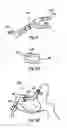 Fig. 06 - Laminoplasty fixation devices