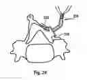 Fig. 11 - Laminoplasty fixation devices