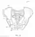 Fig. 02 - Shape adaptable intramedullary fixation device