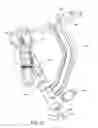 Fig. 35 - Method and apparatus for treating a bone fracture