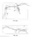 Fig. 47 - Method and apparatus for treating a bone fracture