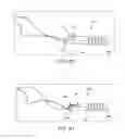 Fig. 48 - Method and apparatus for treating a bone fracture