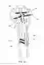 Fig. 52 - Method and apparatus for treating a bone fracture