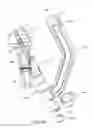 Fig. 55 - Method and apparatus for treating a bone fracture