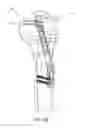 Fig. 63 - Method and apparatus for treating a bone fracture