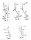 Fig. 15 - Bone plates, screws and instruments