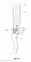 Fig. 02 - Method and apparatus for gastrointestinal tract ablation to achieve loss of persistent and/or recurrent excess body weight following a weight loss operation