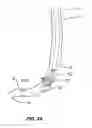 Fig. 06 - Method and apparatus for gastrointestinal tract ablation to achieve loss of persistent and/or recurrent excess body weight following a weight loss operation