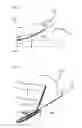 Fig. 04 - ELECTROSURGICAL INSTRUMENT AND METHOD FOR INSERTING AN APPLICATOR INTO BODY LUMINA